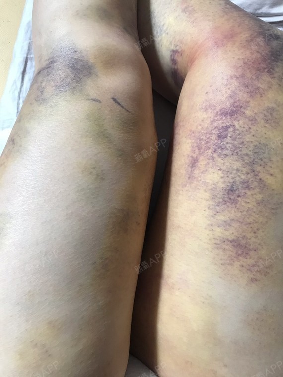 也做了些按摩,脱掉裤子的大腿淤青图片大腿性肿膝关节术后腿部淤青