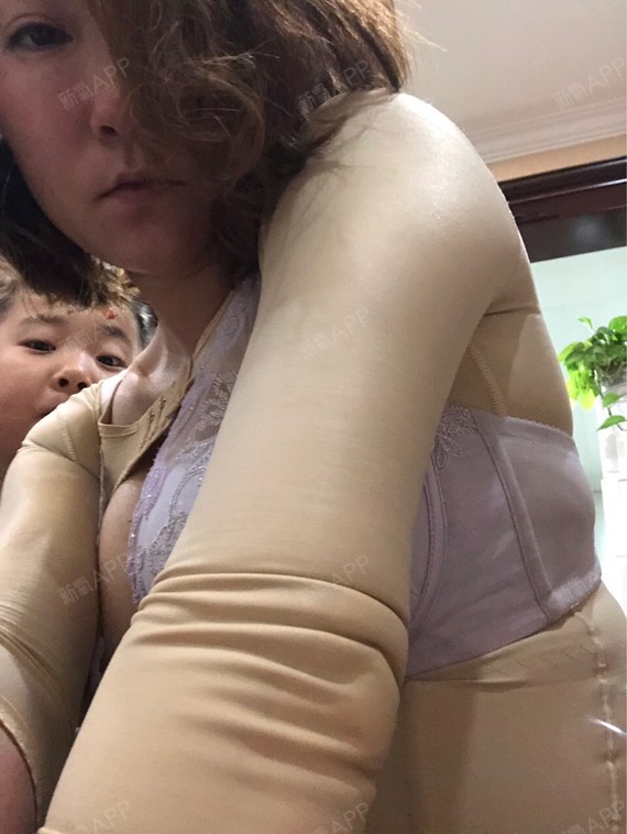 今天左手的下手臂有点肿,可能是昨天吃了个辣鸡爪的缘_圈子-新氧美容