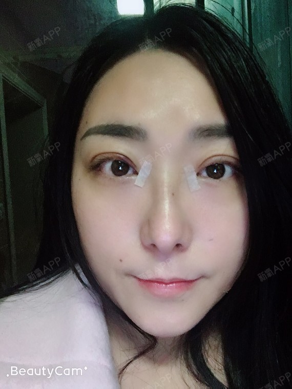 今天是第十四天了,自从做了双眼皮手术以后,我的结膜_圈子-新氧美容
