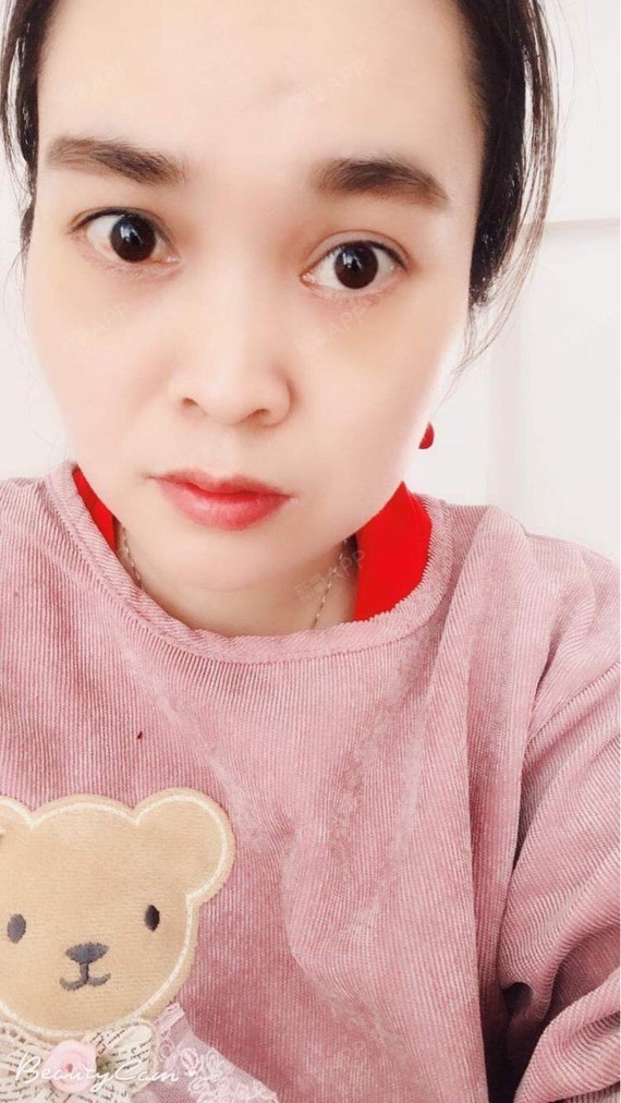 河笑平外切去眼袋第7天美丽日记