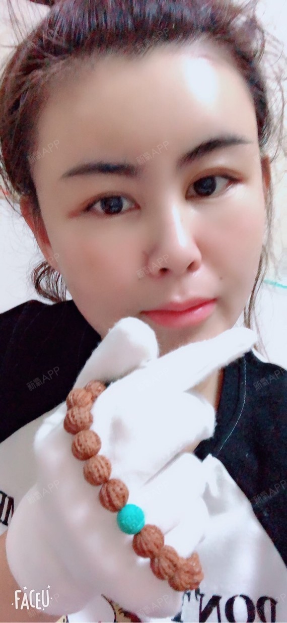 自体脂肪面部填充