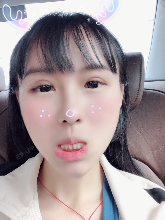 通过新氧消费方案查看切开双眼皮手术中度疼痛双眼皮