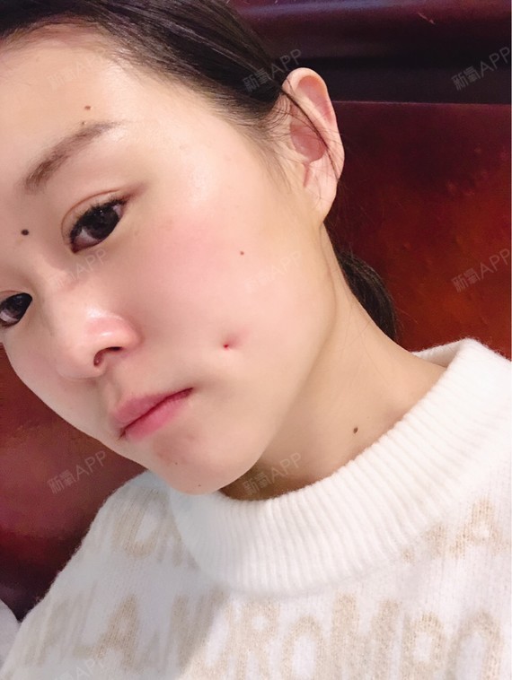 酒窝成形术