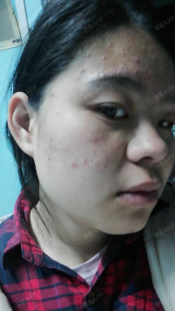 氧气zbsb8清痘针第0天美丽日记