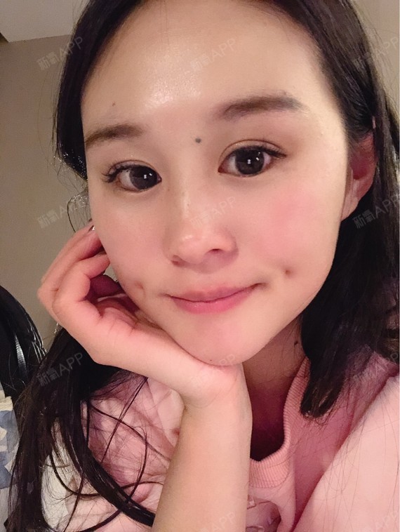 成形术好不好_效果图_喜乐_419267酒窝成形术术后第4天_新氧美容整形