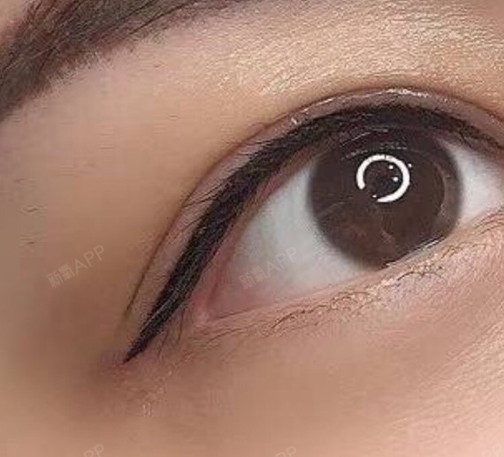 广州半永久美瞳线好不好_效果图_氧气8xy565a半永久美瞳线术后第5天