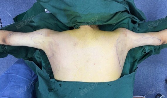 在菲丝澜做了手臂肩胛的黄金微雕吸脂,我本身的身材还_圈子-新氧美容