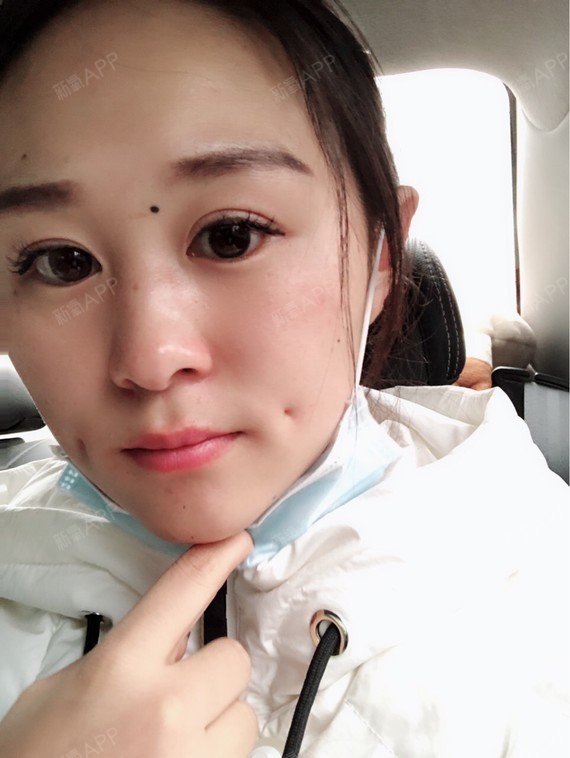 喜乐_419267酒窝成形术第7天美丽日记