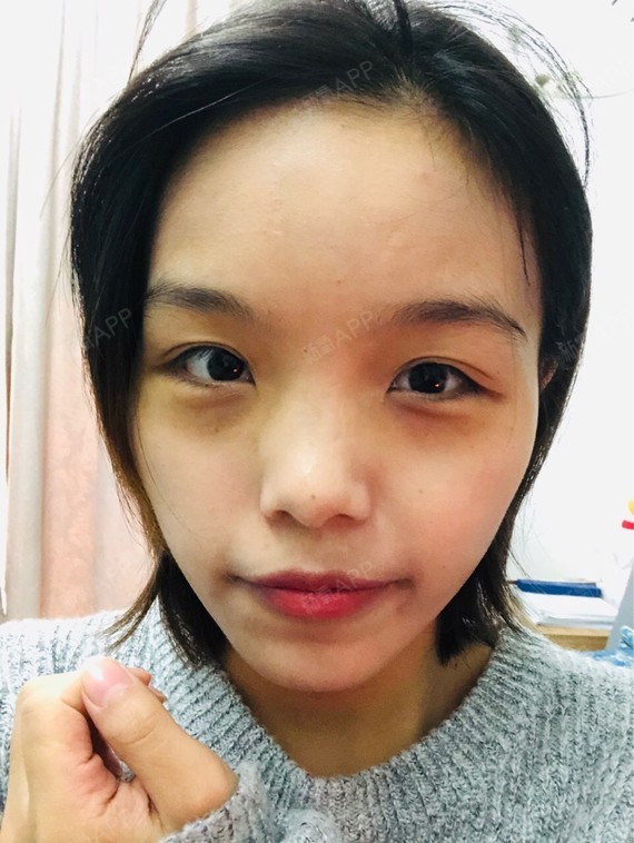 激光去眼袋