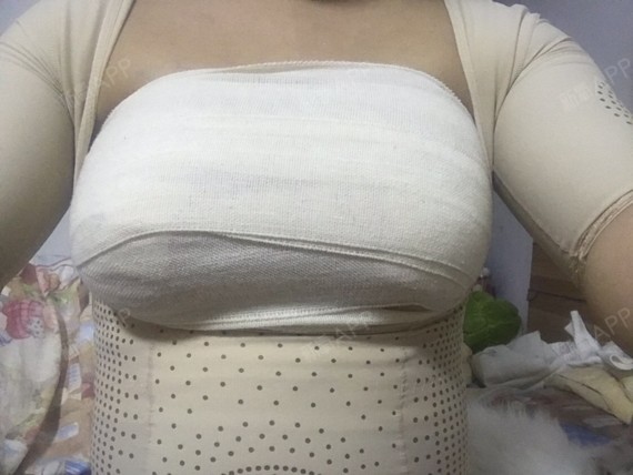 明天就可以先拆胸部的线了.