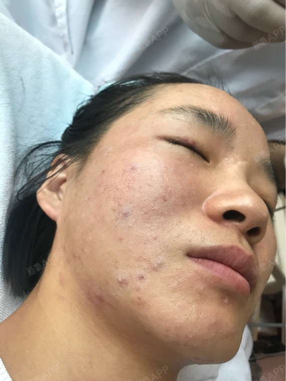 氧气zcox8红蓝光祛痘第0天美丽日记