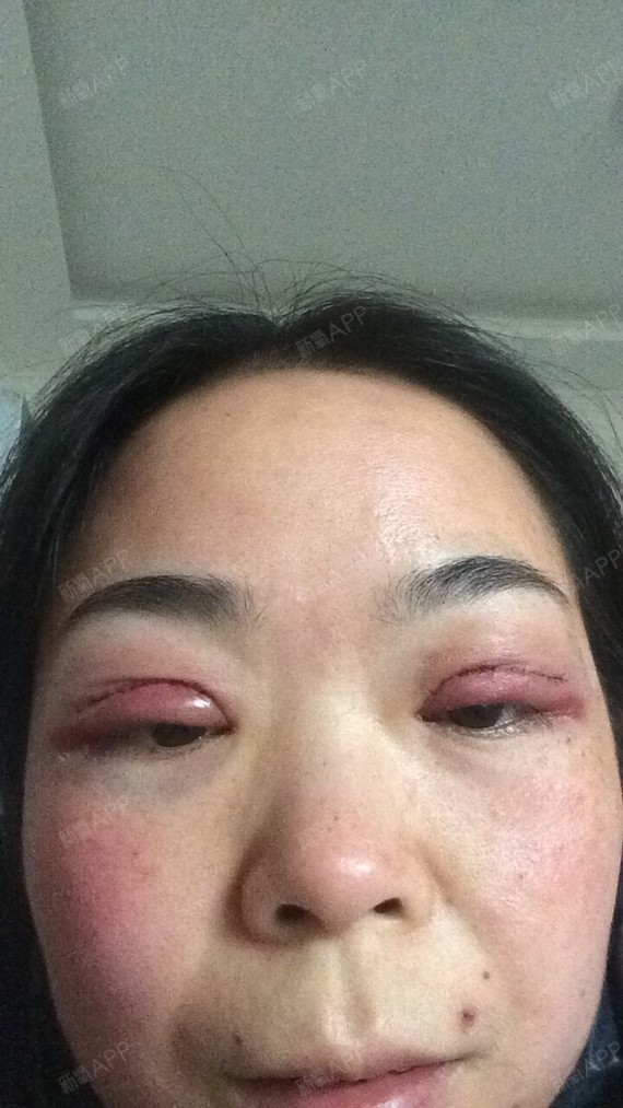 这张是手术第二天拆了纱布的时候,也不是很肿,冰敷了眼睛很舒服