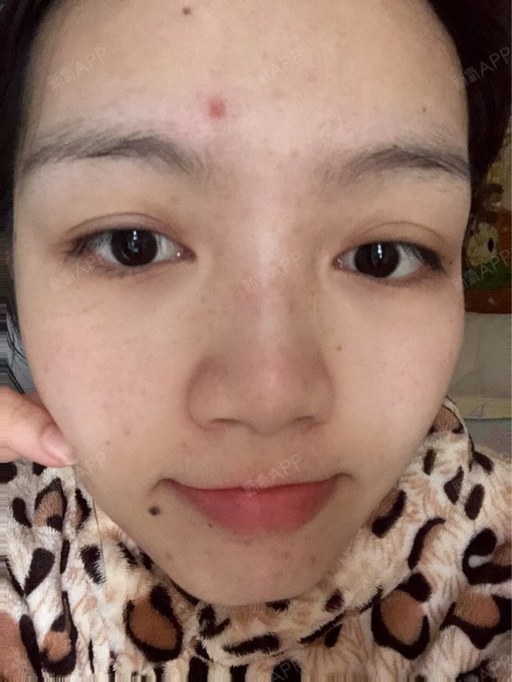 下巴的几颗痘印!很顽强 长了很久了.下次有机会也去把痘印另外去了.