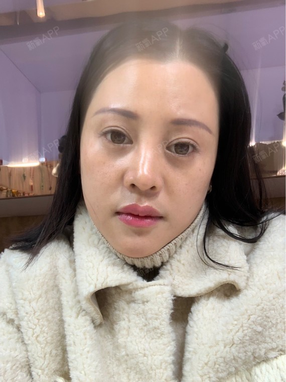 江苏南京拉皮手术提升好不好_效果图_陶陶卖水晶的小姑娘拉皮手术提升