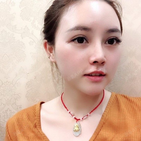 自体脂肪填充卧蚕