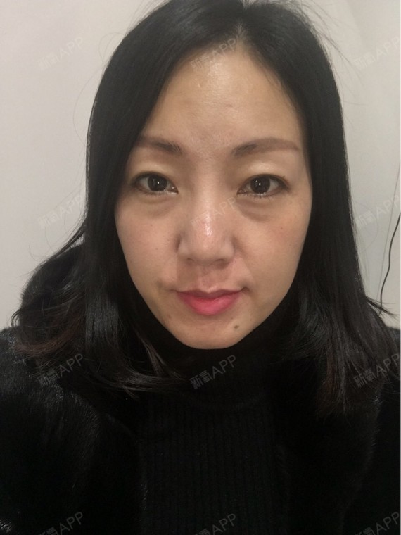 新氧- 王财女 | 眼部 | 眼袋 | 内切去眼袋 | 术后当自强 | 沈阳同城