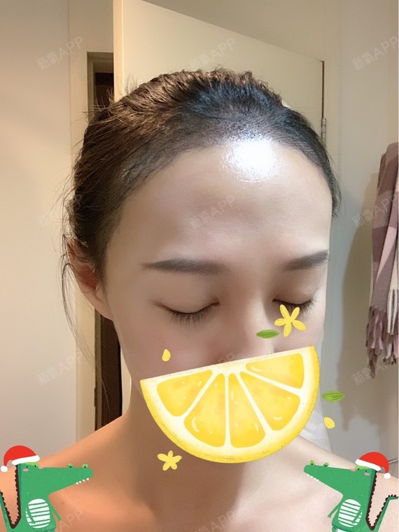 糖糖叶叶种植发际线第4天美丽日记