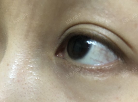 【上海瑰康医疗美容】【下眼下至/外切-王屏院长】2_圈子-新氧美容