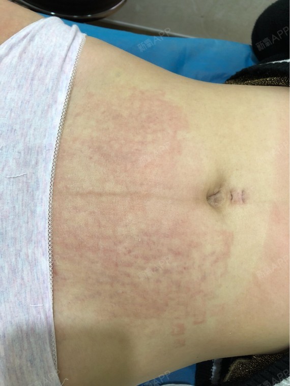 再一次的手术前后对比