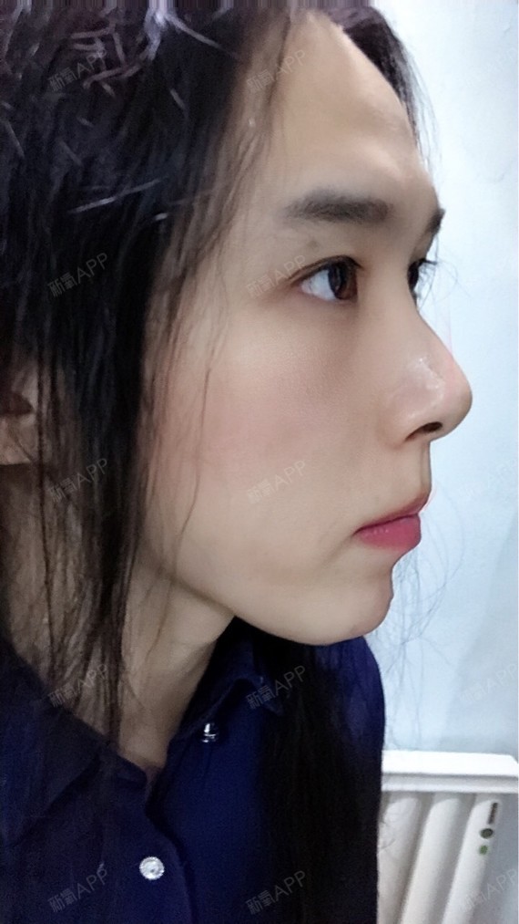 上下颚手术/突嘴矫正好不好_效果图_嘟嘟哥上下颚手术/突嘴矫正术后第