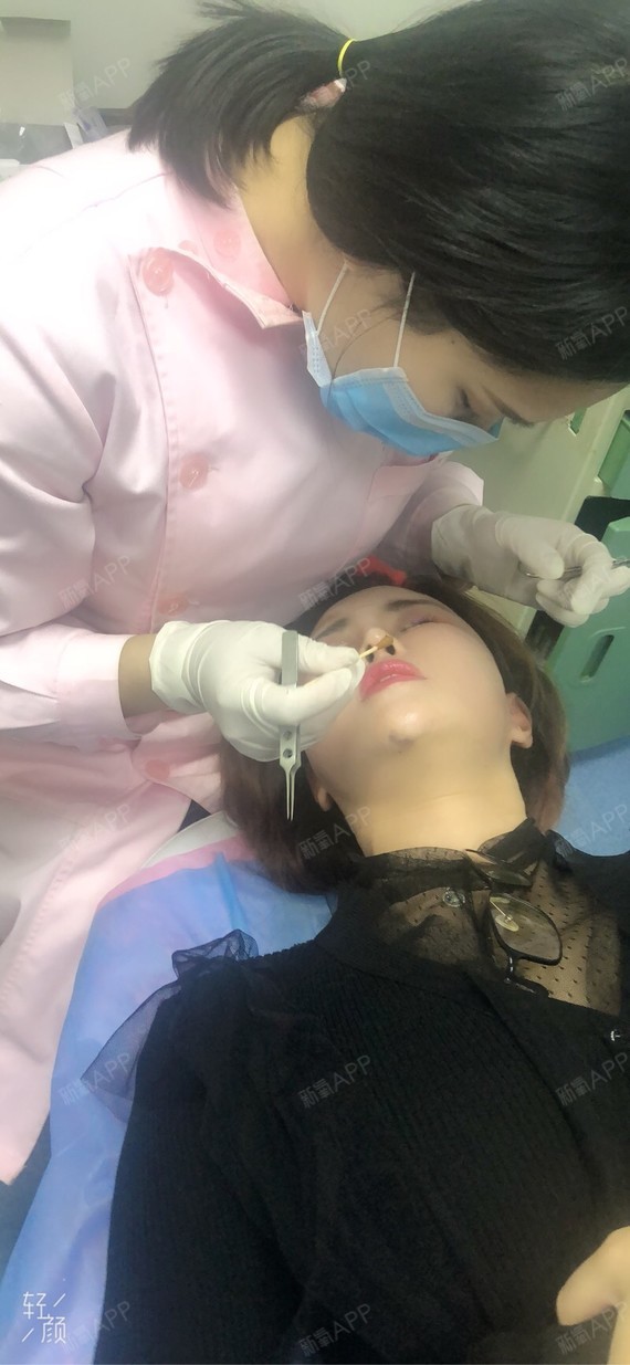 平躺拆线发现鼻尖确实翘起来了 而且伤口一点也不明显 圈子 新氧美容整形