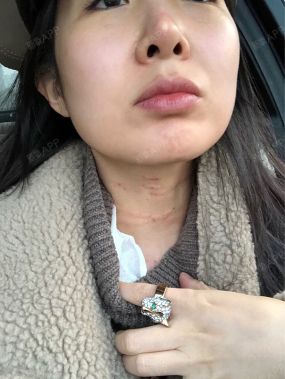 西安玻尿酸去颈纹好不好_效果图_汐大帝17玻尿酸去颈纹术后第0天_新氧