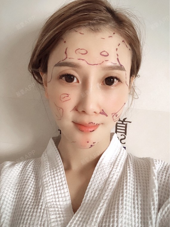 面部饱满也还可以 主要就是之前玻尿酸填充加上后期补 整个额头实在不