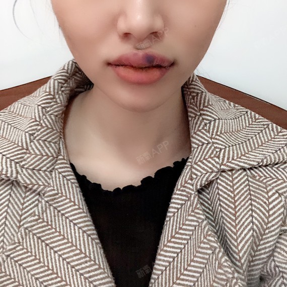 第三天了消肿了很多特别是下嘴唇