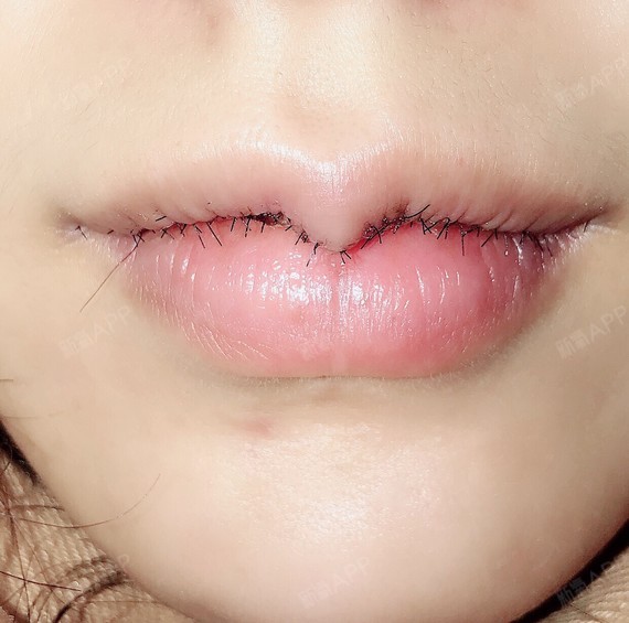 厚唇组织切除术