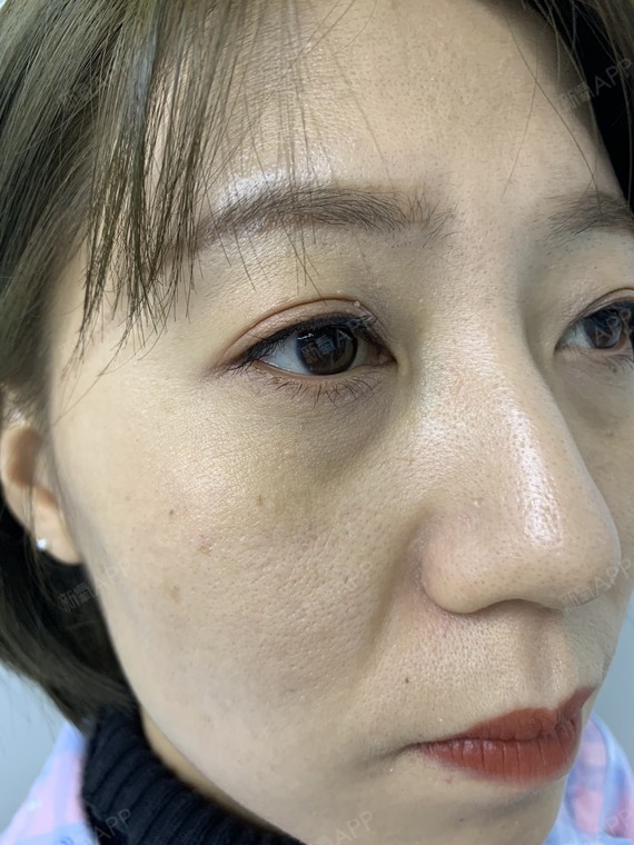 本来就感觉睡眠不好导致黑眼圈很严重 再加上泪沟