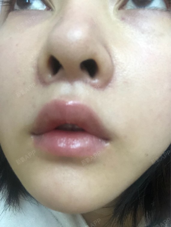 人中缩短术好不好_效果图_did人中缩短术术后第8天_新氧美容整形