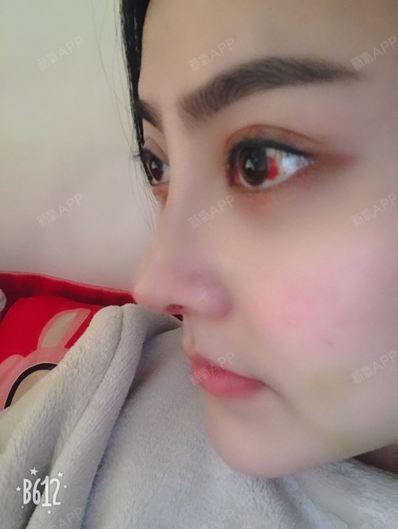 肋软骨隆鼻好不好_效果图_子薰肋软骨隆鼻术后第15天_新氧美容整形
