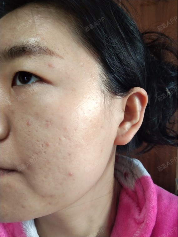 超皮秒点阵祛痘坑术后3天:应该不是错觉吧,感觉肤色_圈子-新氧美容