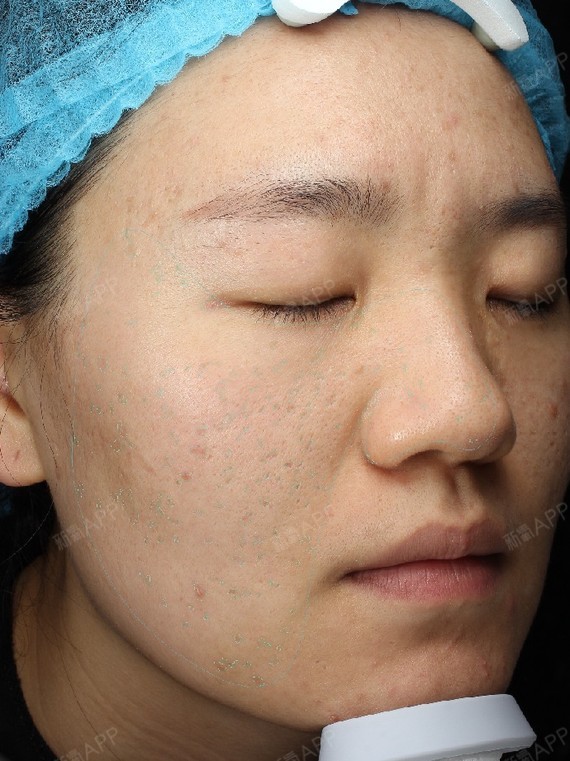 超皮秒点阵祛痘坑术后3天:应该不是错觉吧,感觉肤色_圈子-新氧美容