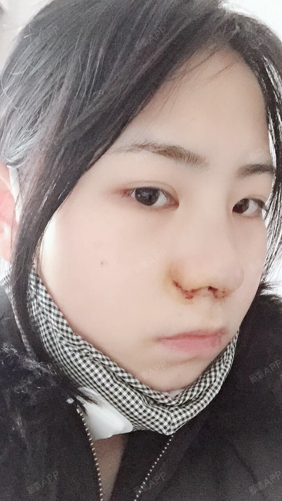 小三叔手术缩鼻翼第3天美丽日记