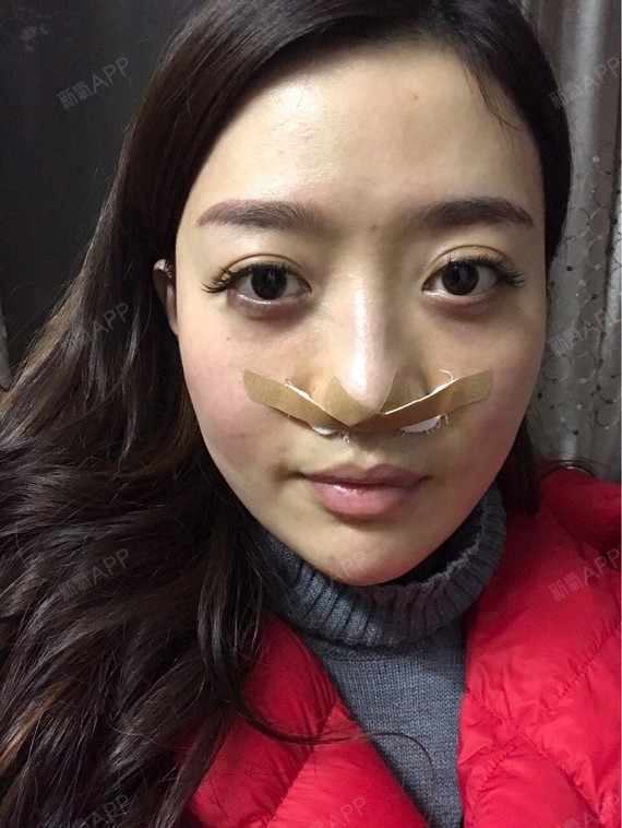 【武汉广爱医院手术缩鼻翼术后当天】想了很久终于把心_圈子-新氧美容