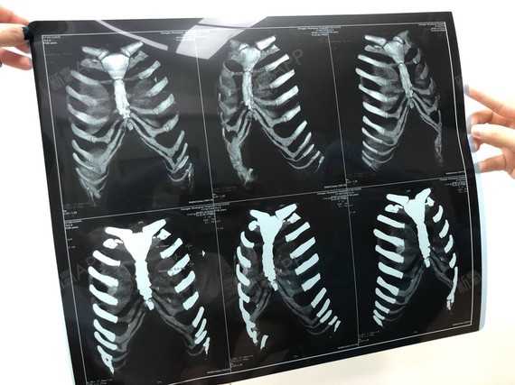 才取纱布,等取了纱布看效果~今天第三天,下面是我取出来的硅胶和ct片