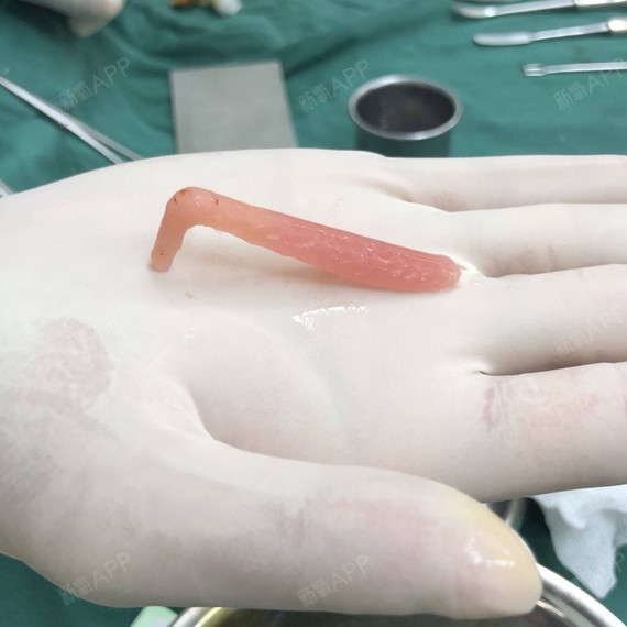 今天第三天,下面是我取出来的硅胶和ct片,最后一个是做