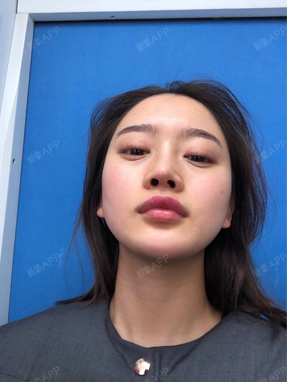 自体软骨垫鼻尖