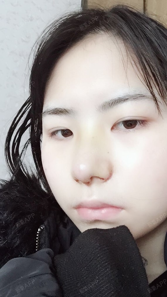 【武汉广爱医院手术缩鼻翼第7天】第七天了,拆线了,_圈子-新氧美容