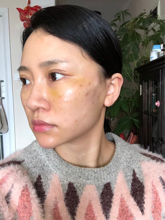 脸消肿了一些,昨天去医院复查了一下,王院帮我稍微调_圈子-新氧美容