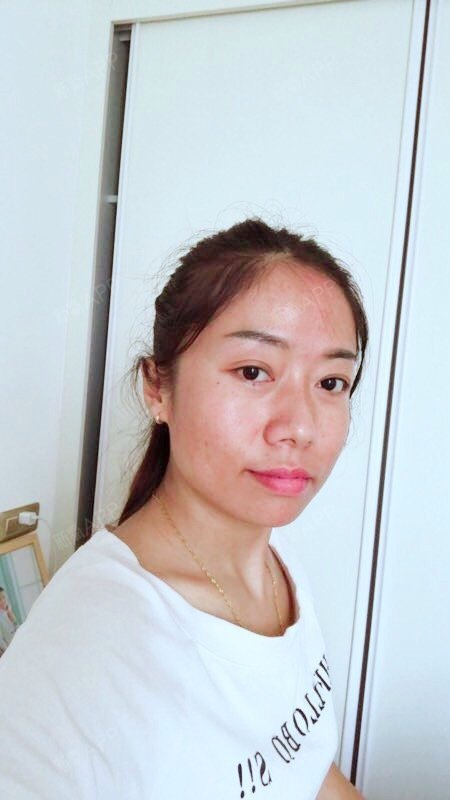 米哦漏美白针第10天美丽日记