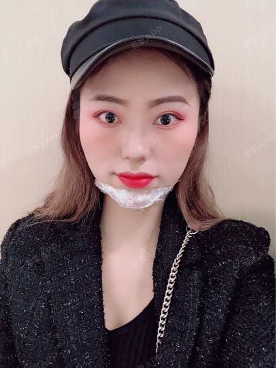 今天是注射玻尿酸下巴和瘦脸针术后19天