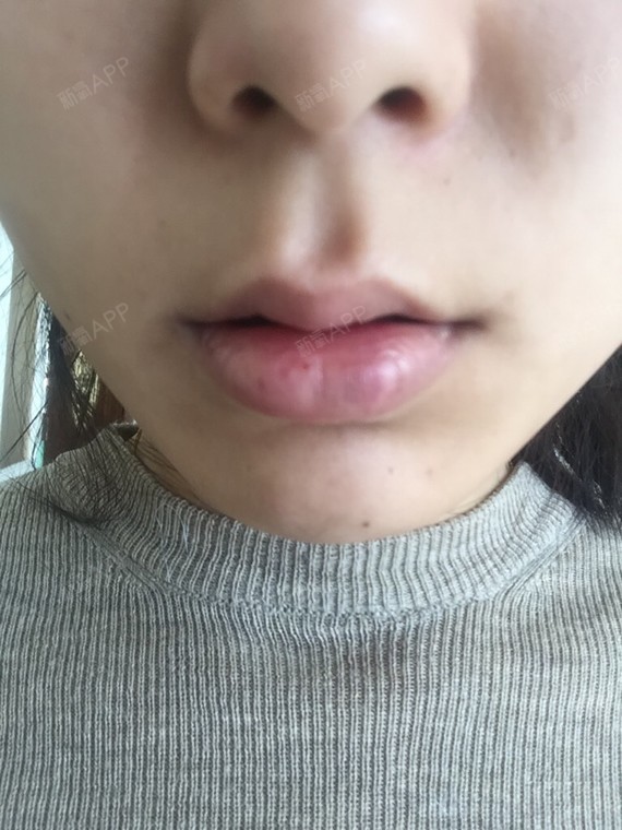 通过新氧消费方案查看玻尿酸丰唇注射因人而异唇型美化