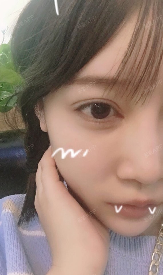 缩短术好不好_效果图_千与大姐姐i人中缩短术术后第7天_新氧美容整形