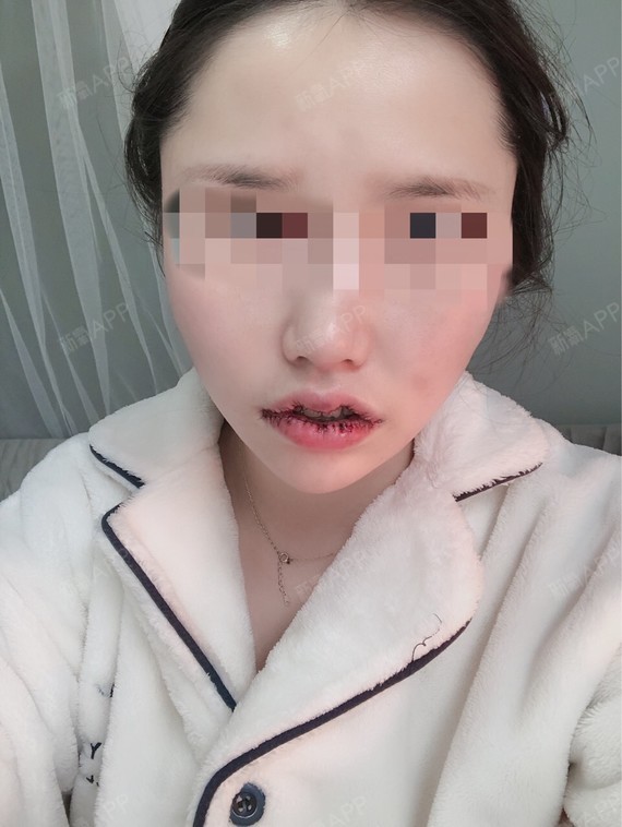 氧气_zjjw8d8a5m唇手术第1天美丽日记