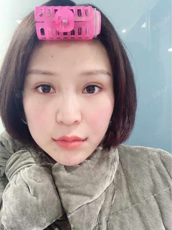 成都嘴角上扬术好不好_效果图_我要变成瘦瘦的美女嘴角上扬术术后第10