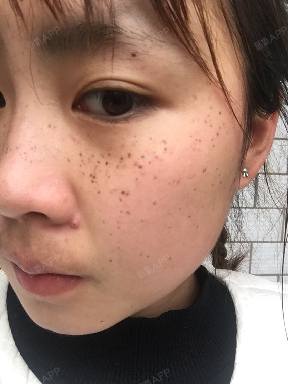 成都激光祛斑好不好_效果图_氧气yxxv1激光祛斑术后第12天_新氧美容
