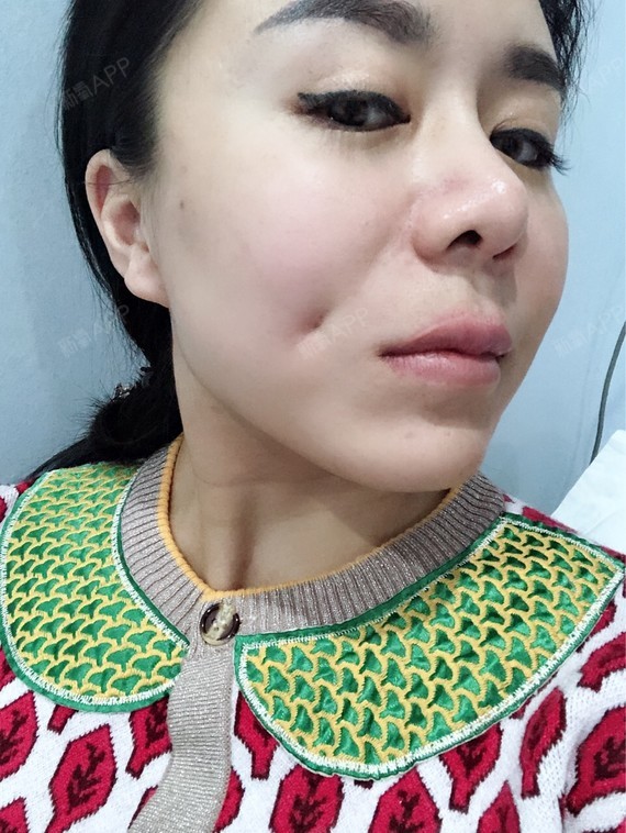 后即可效果原本就是一侧有酒窝,但是不明显,想要酒_圈子-新氧美容整形
