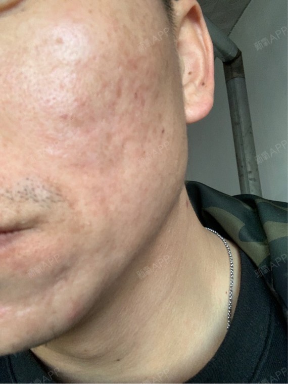 结痂脱落期了,不知道是不是这个样子